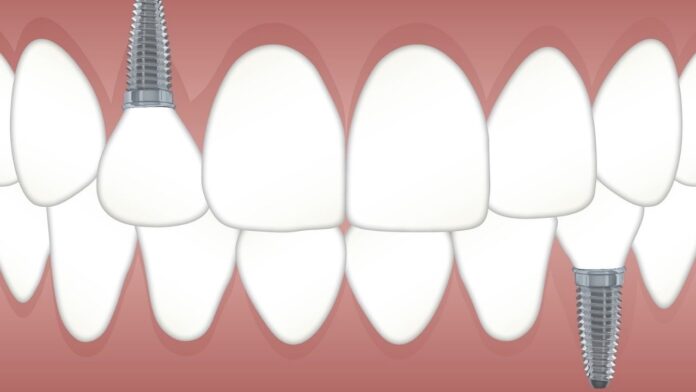 facts about dental implants
